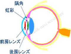 フェイキックIOLイメージ6.jpg